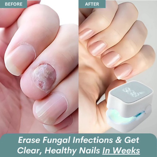 ClearNail Pro™ - Nail Fungus Laser Device